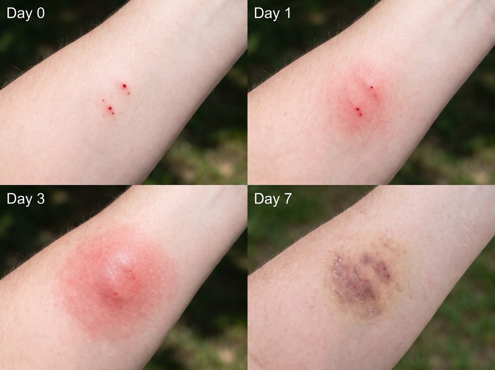 Four-panel progression photo showing a giant desert centipede bite healing from day zero through day seven